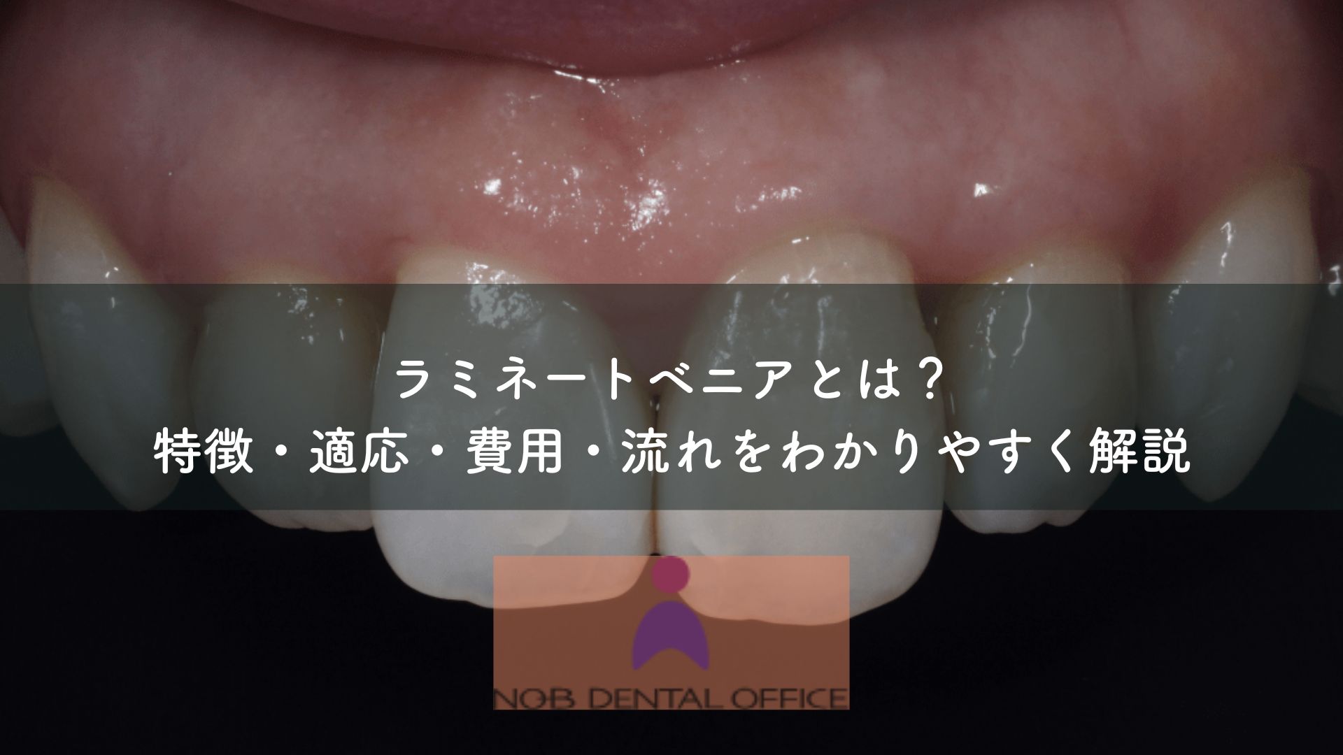 ラミネートベニアとは？特徴・適応・費用・流れをわかりやすく解説